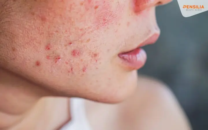 [hỏi Đáp] Bị Mụn Có Nên Đi Khám Bác Sĩ Da Liễu Không?