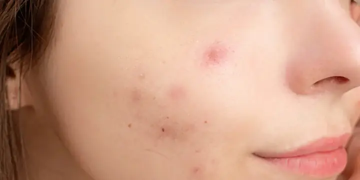 Cách Chăm Sóc Da Mụn Tại Spa Cách Chăm Sóc Da Mụn Tại Spa