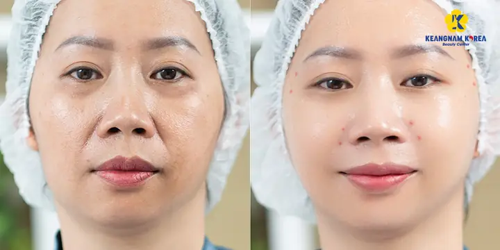 Trẻ Hoá Da Bằng Công Nghệ Căng Cơ Nội Soi