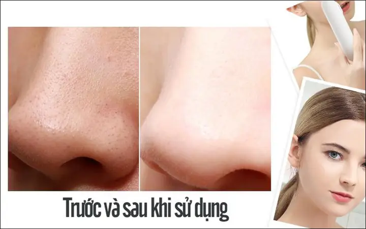 Trong Khi Hút Mụn