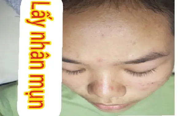 Lấy Nhân Mụn