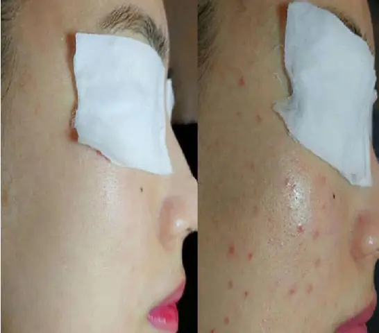 Lấy Nhân Mụn Tại Spa Ngoc Trinh Mang Đến Nhiều Lợi Ích