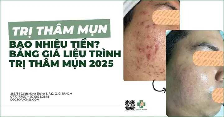 Trị Thâm Mụn Bao Nhiêu Tiền? Bảng Giá Liệu Trình Trị Thâm Mụn 2025