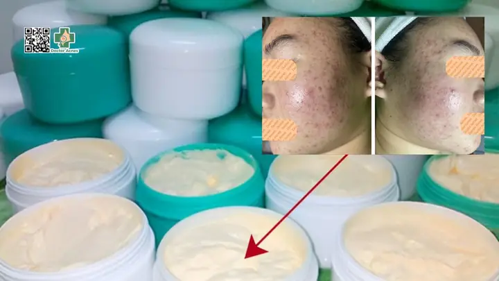 Đối Với Mụn Trung Bình, Mụn Nặng Và Các Trường Hợp Khác Đối Với Mụn Trung Bình, Mụn Nặng Và Các Trường Hợp Khác