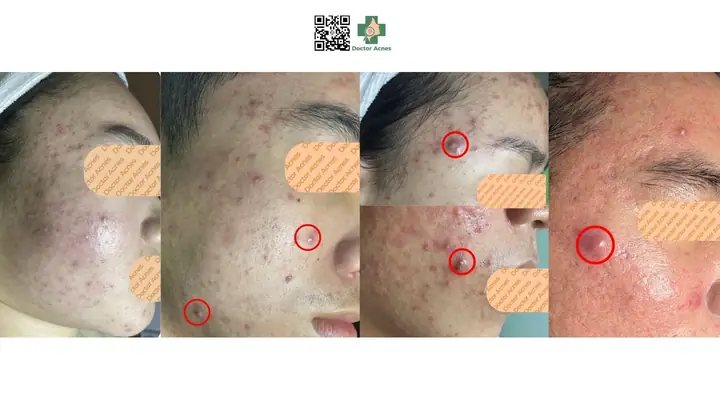 Mụn Trung Bình Và Nặng Mụn Trung Bình Và Nặng