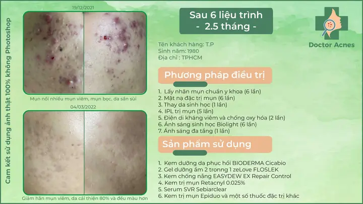 Đối Với Mụn Trung Bình, Mụn Nặng Và Các Trường Hợp Khác Đối Với Mụn Trung Bình, Mụn Nặng Và Các Trường Hợp Khác