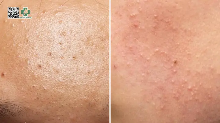 Mụn Nhẹ Mụn Nhẹ