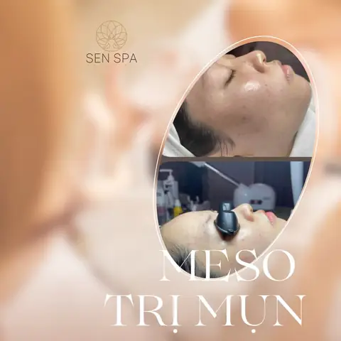 Meso Trị Mụn Tại Long Biên: Cải Thiện "thần Kỳ" Cho Làn Da Mụn Hiệu ...
