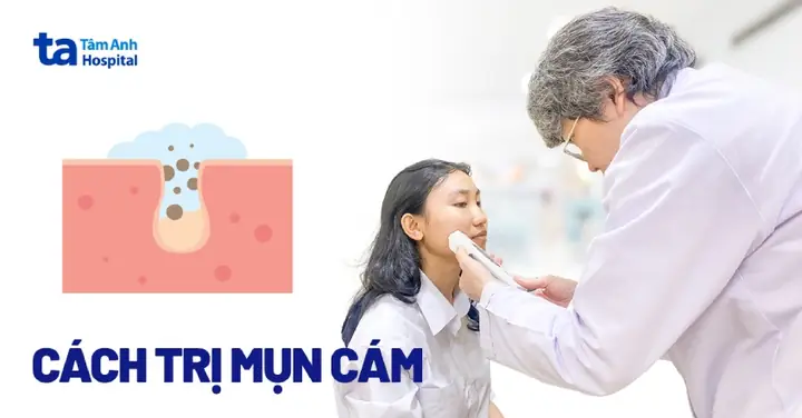 Cách Trị Mụn Cám Tại Nhà Hết Sạch Hiệu Quả An Toàn Dễ Áp Dụng