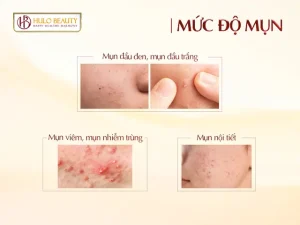 Mức Độ Mụn