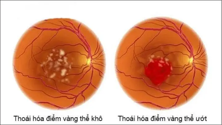 Giảm Nguy Cơ Thoái Hóa Điểm Vàng
