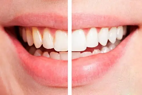 7/tẩy Trắng Räng 7/tẩy Trắng Räng