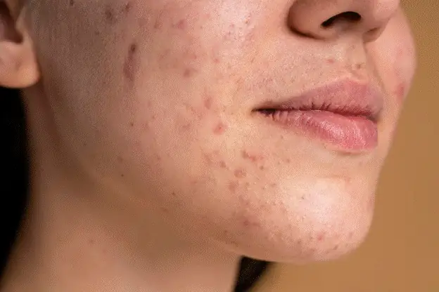 Có Nên Đi Spa Nặn Mụn Không Và Lời Khuyên Từ Chuyên Gia Da Liễu Có Nên Đi Spa Nặn Mụn Không Và Lời Khuyên Từ Chuyên Gia Da Liễu