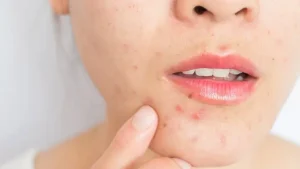 Lấy Nhân Mụn Có Tốt Không? Khi Nào Thì Nên Lấy Nhân Mụn?