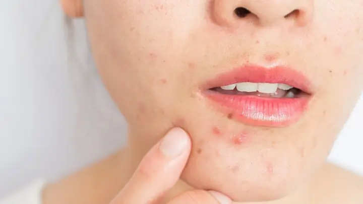 Lấy Nhân Mụn Có Tốt Không? Khi Nào Thì Nên Lấy Nhân Mụn?