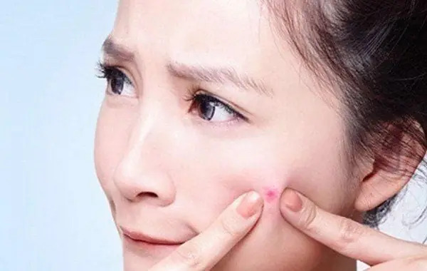 Nặn Mụn Có Tốt Không? | Vinmec Nặn Mụn Có Tốt Không? | Vinmec