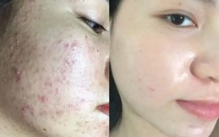 Những Lưu Ý Sau Khi Chăm Sóc Da Mặt Cơ Bản Tại Mai Beauty Spa