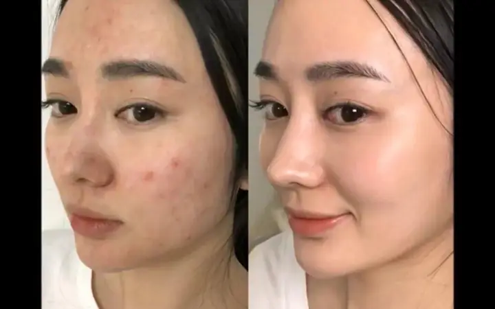 Những Lưu Ý Sau Khi Chăm Sóc Da Mặt Cơ Bản Tại Mai Beauty Spa