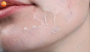 Ảnh Hưởng Của Thời Tiết Hanh Khô Đến Sức Khỏe Con Người