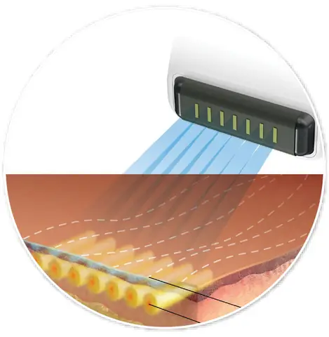 Sofwave Superbtm Trẻ Hoã¡ Da Á» Äã¢u Báºc Nhất Sofwave Superbtm Trẻ Hoã¡ Da Á» Äã¢u Báºc Nhất