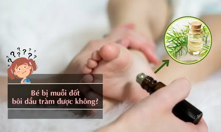 Bé Bị Muỗi Đốt Bôi Dầu Tràm Được Không? Lưu Ý Khi Dùng – Natonic ...