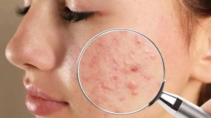Nguyên Nhân Khiến Nhiều Người Bị Mụn Ở Da?