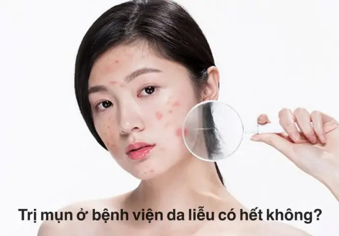 Trị Mụn Ở Bệnh Viện Da Liễu Có Hết Không