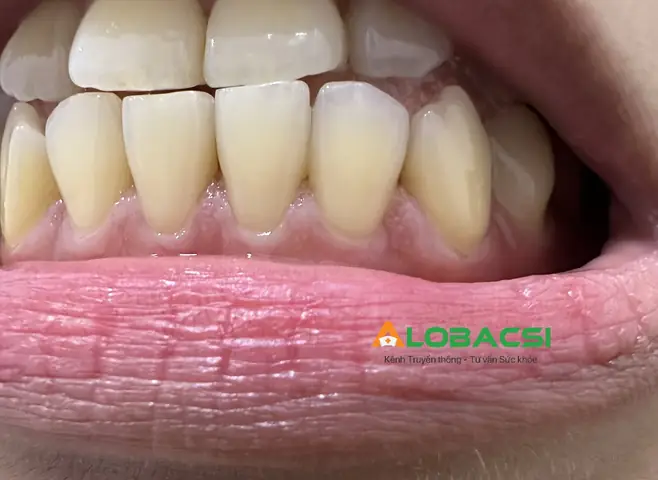 Lòng Bàn Tay Và Bàn Chân Nóng Rát: Nguyên Nhân Và Cách Xử Lý Hiệu Quả Lòng Bàn Tay Và Bàn Chân Nóng Rát: Nguyên Nhân Và Cách Xử Lý Hiệu Quả