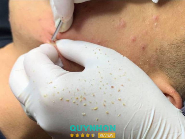 spa lấy nhân mụn gần đây - Hình 2