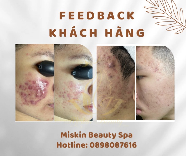 spa lấy nhân mụn gần đây - Hình 4