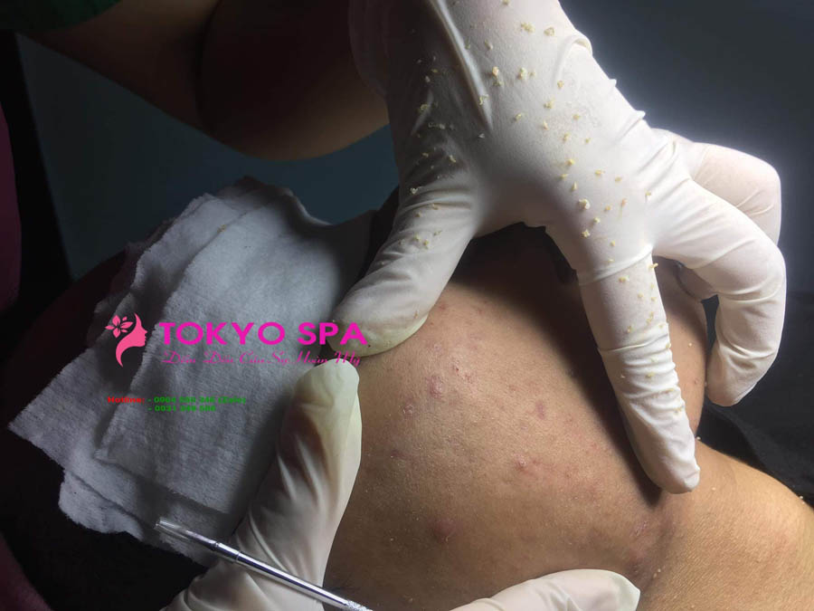 spa lấy nhân mụn gần đây