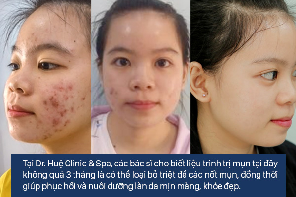 1 liệu trình trị mụn tại spa bao nhiêu tiền - Hình 3