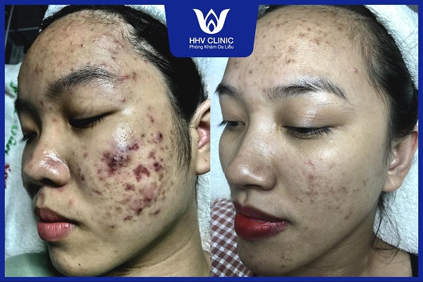 1 liệu trình trị mụn tại spa bao nhiêu tiền - Hình 5